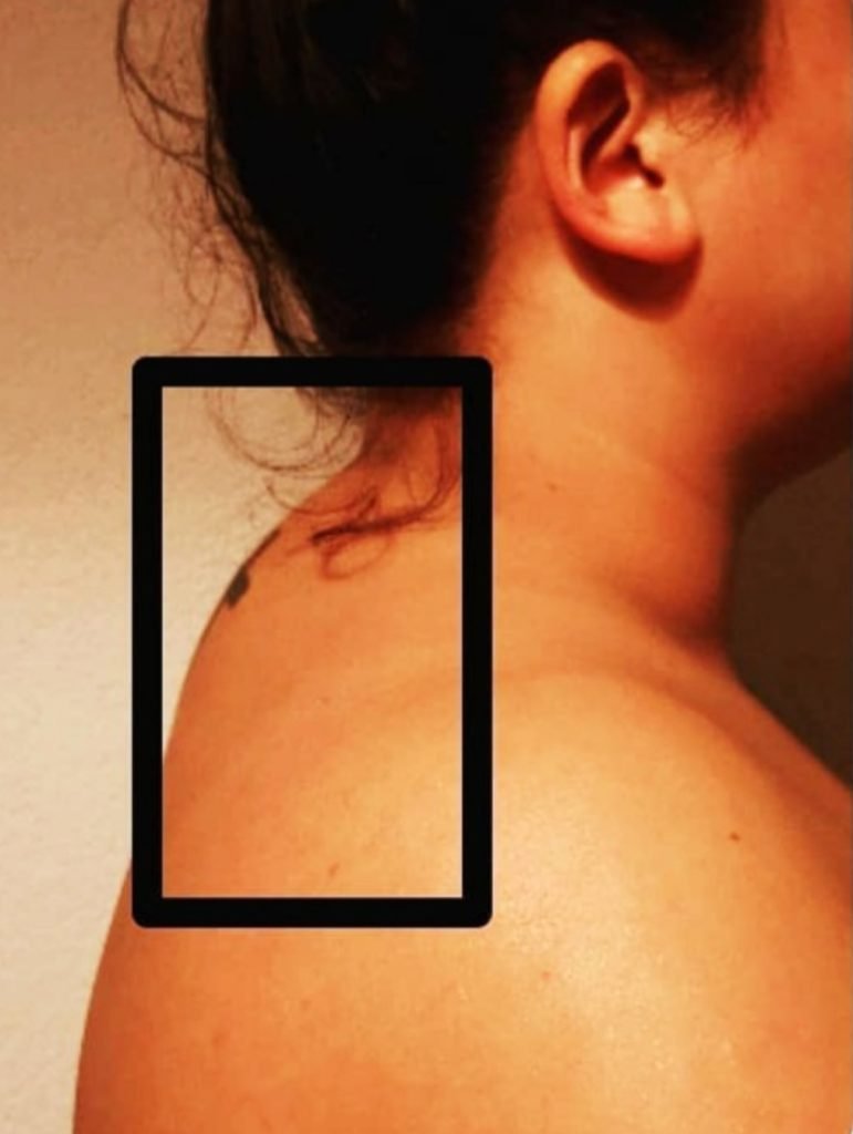 over transformational cupping resultaat van cupping