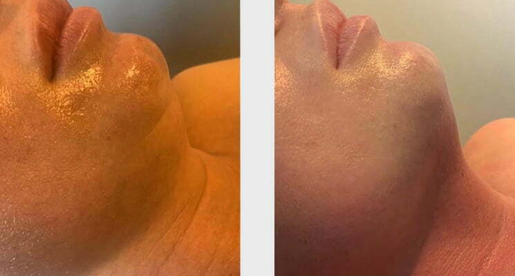 formation au cupping transformationnel 2