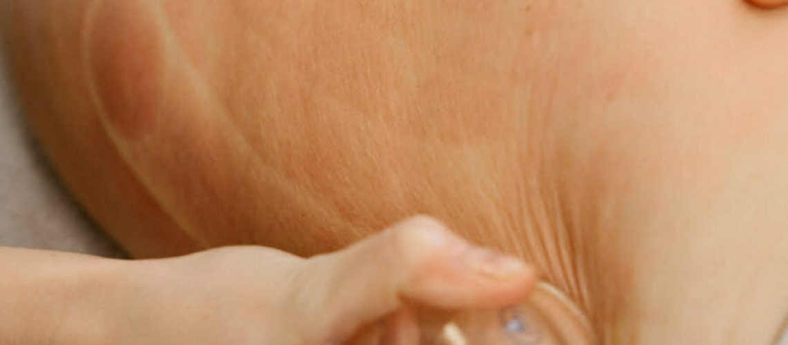 تجربة الحجامة التحويلية مدونة الحجامة التحويلية 2